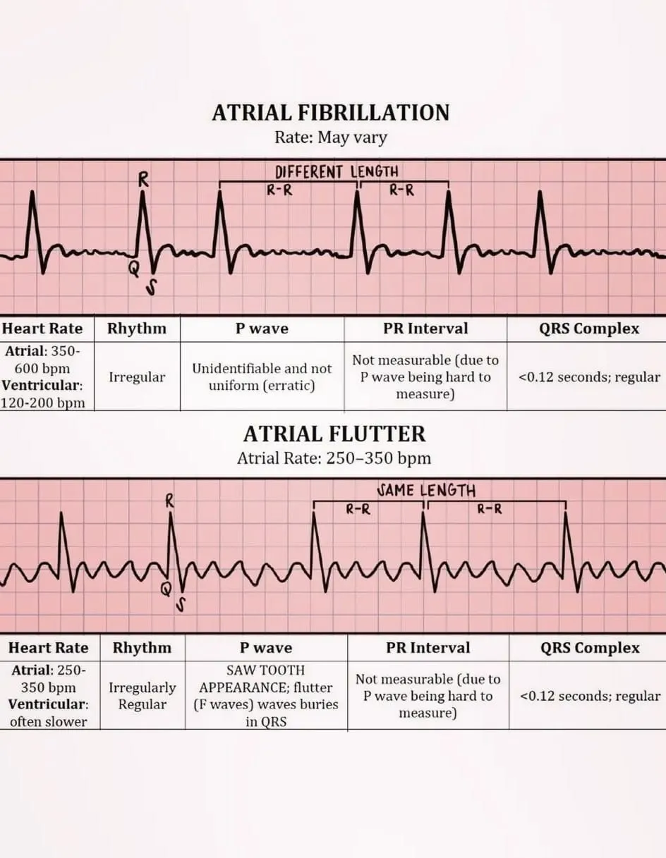 Atrial fib vs atrial flutter on an ECG